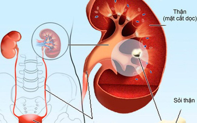 Nhắc bạn những điều quan trọng giúp thận khoẻ, tránh được các bệnh nguy hiểm